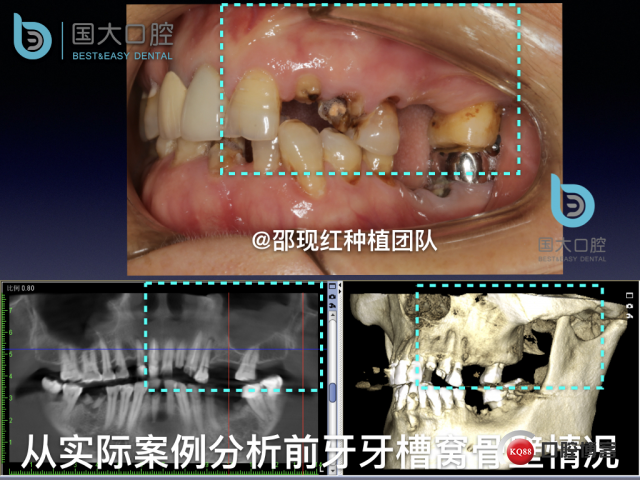 沙迪明 左上1即刻种植 牙片保留术.009.jpeg