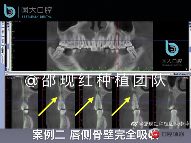 沙迪明 左上1即刻种植 牙片保留术.012.jpeg