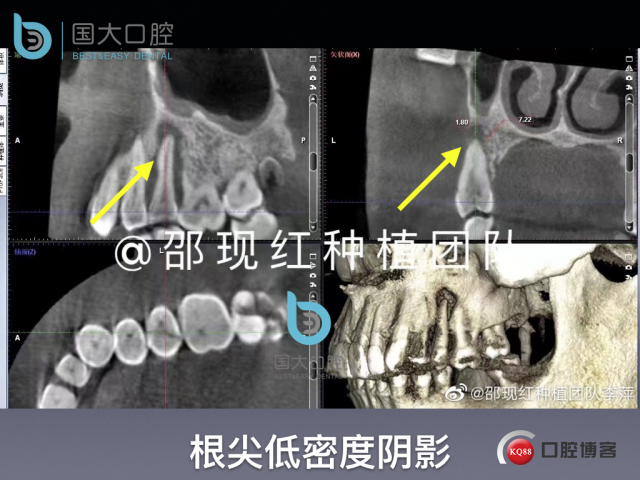 沙迪明 左上1即刻种植 牙片保留术.013.jpeg