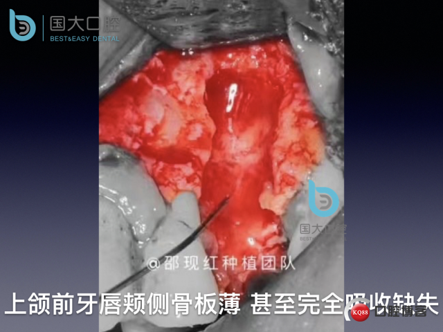 沙迪明 左上1即刻种植 牙片保留术.015.jpeg