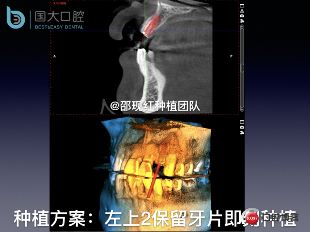 沙迪明 左上1即刻种植 牙片保留术.024.jpeg