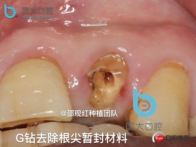 沙迪明 左上1即刻种植 牙片保留术.028.jpeg