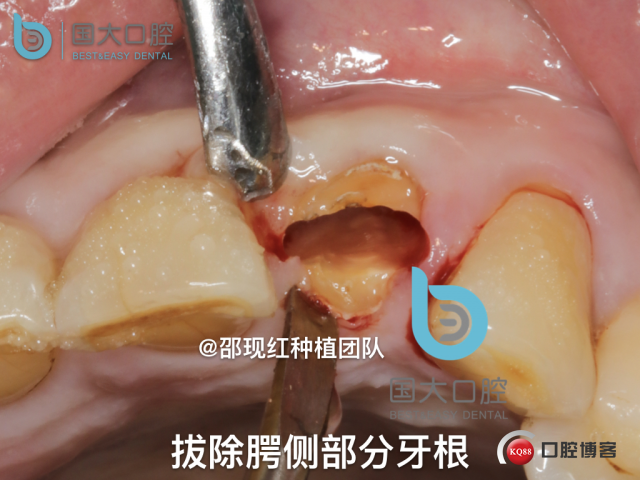 沙迪明 左上1即刻种植 牙片保留术.032.jpeg