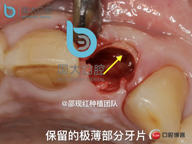 沙迪明 左上1即刻种植 牙片保留术.035.jpeg