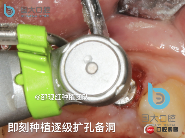 沙迪明 左上1即刻种植 牙片保留术.037.jpeg