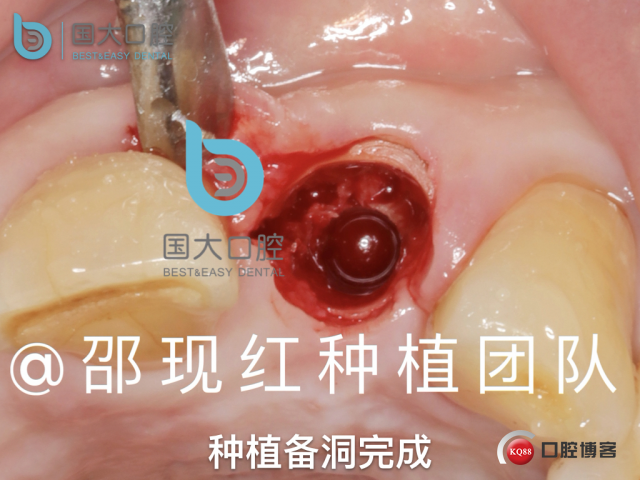 沙迪明 左上1即刻种植 牙片保留术.039.jpeg