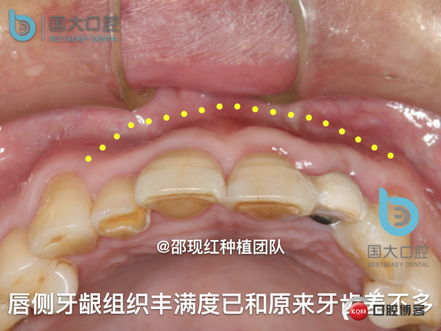 沙迪明 左上1即刻种植 牙片保留术.064.jpeg