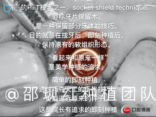 沙迪明 左上1即刻种植 牙片保留术.065.jpeg