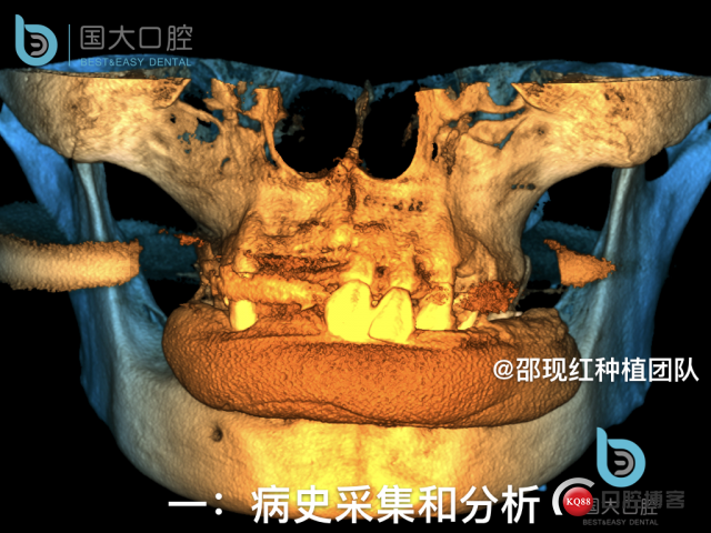 牛立匀 颏孔前种植.003.jpeg