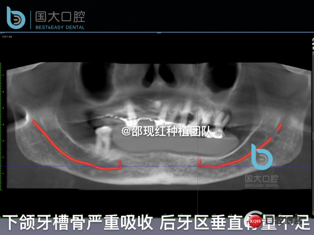 牛立匀 颏孔前种植.008.jpeg