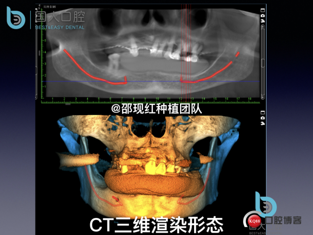 牛立匀 颏孔前种植.009.jpeg