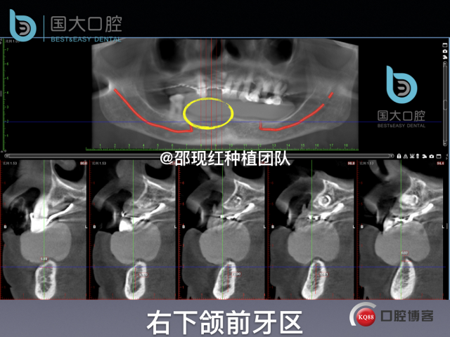 牛立匀 颏孔前种植.011.jpeg