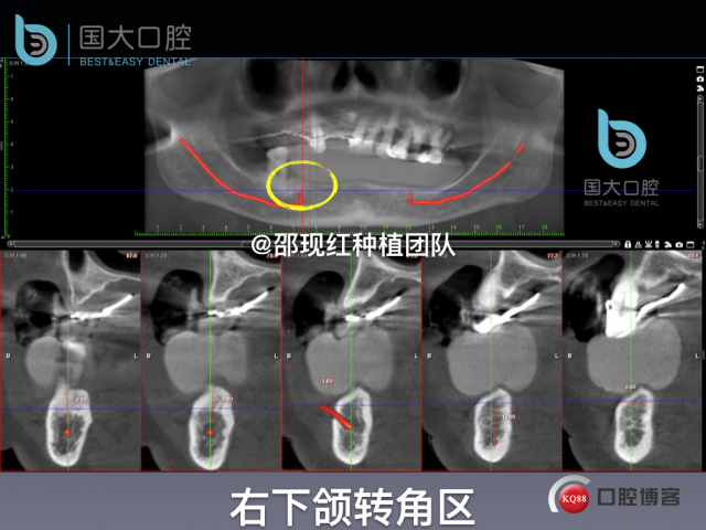 牛立匀 颏孔前种植.012.jpeg