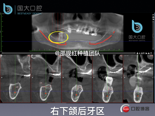 牛立匀 颏孔前种植.013.jpeg