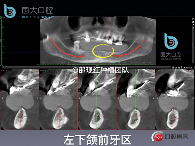 牛立匀 颏孔前种植.014.jpeg