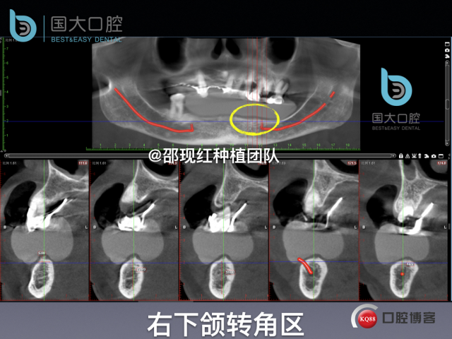 牛立匀 颏孔前种植.015.jpeg