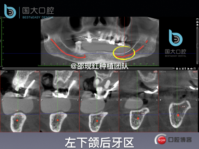 牛立匀 颏孔前种植.016.jpeg