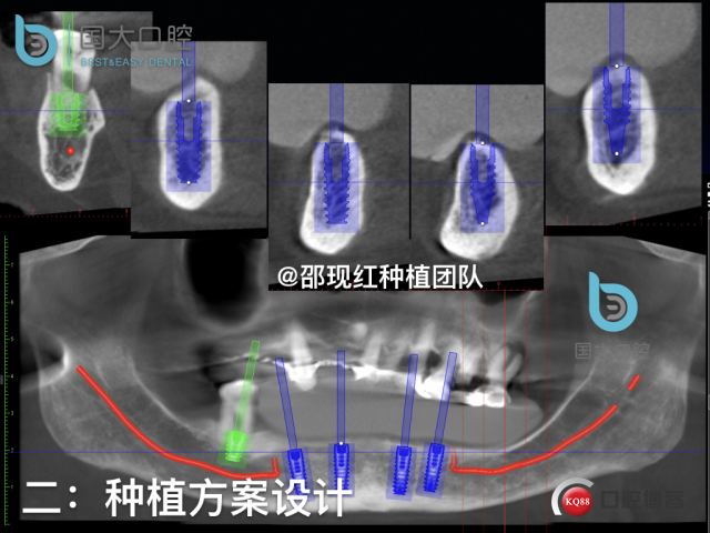 牛立匀 颏孔前种植.019.jpeg