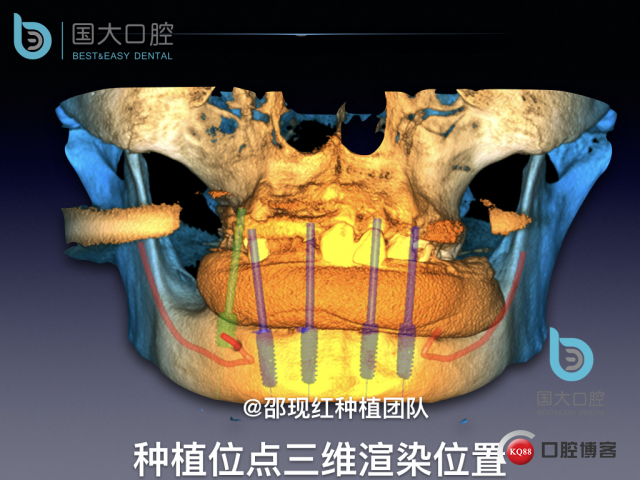 牛立匀 颏孔前种植.021.jpeg