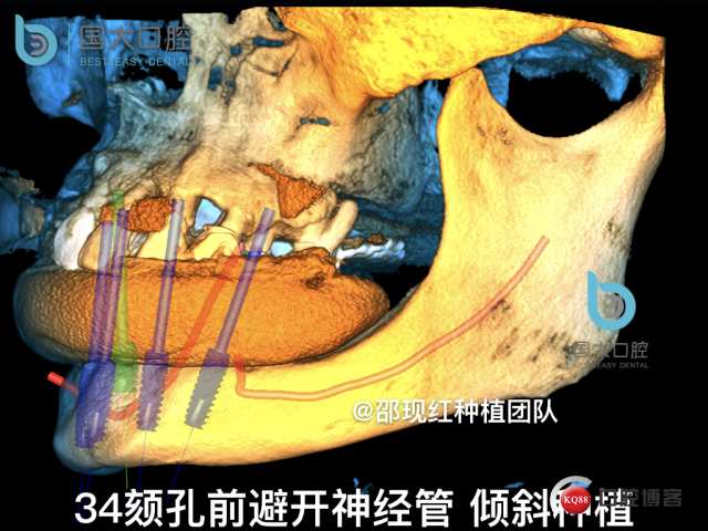 牛立匀 颏孔前种植.022.jpeg