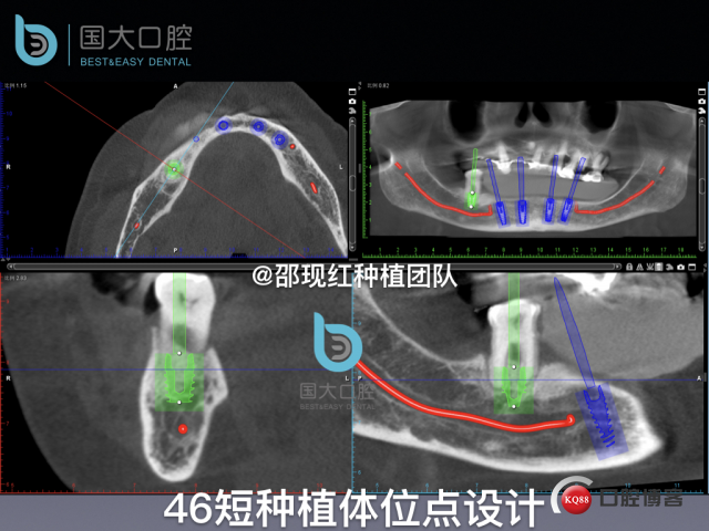 牛立匀 颏孔前种植.024.jpeg