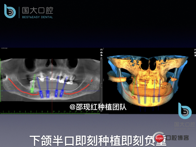 牛立匀 颏孔前种植.025.jpeg
