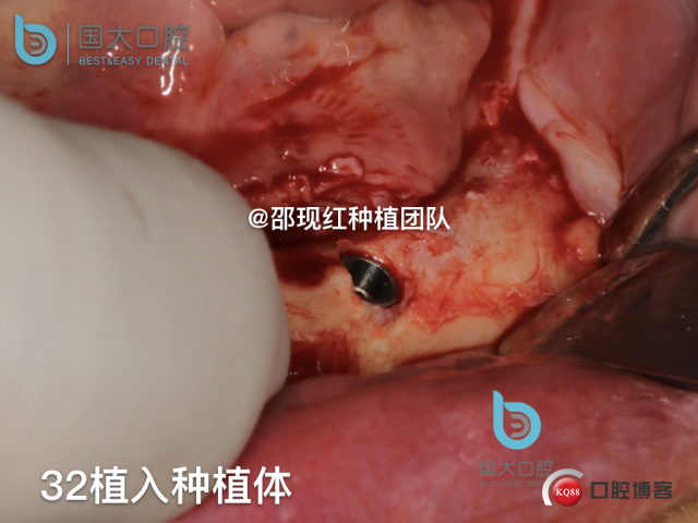 牛立匀 颏孔前种植.030.jpeg