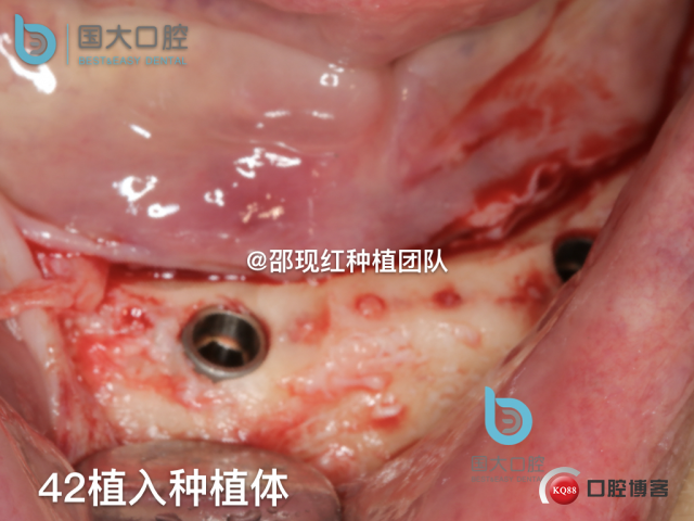 牛立匀 颏孔前种植.031.jpeg