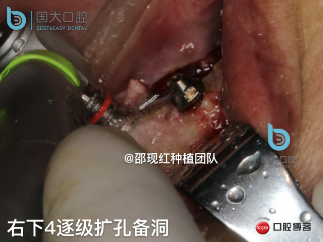 牛立匀 颏孔前种植.036.jpeg
