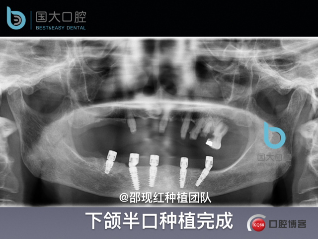 牛立匀 颏孔前种植.042.jpeg