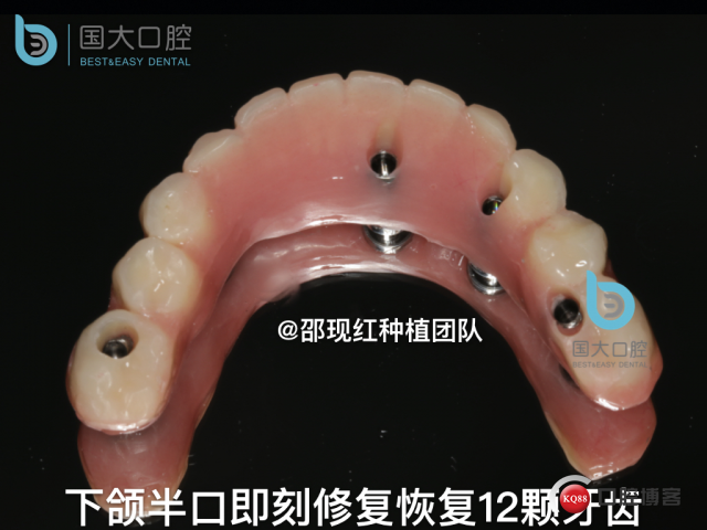 牛立匀 颏孔前种植.045.jpeg