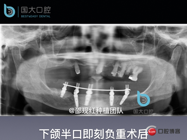 牛立匀 颏孔前种植.046.jpeg