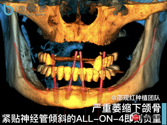 王月秀 下颌种植四颗 下颌骨严重萎缩.001.jpeg