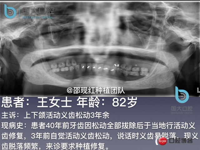 王月秀 下颌种植四颗 下颌骨严重萎缩.002.jpeg