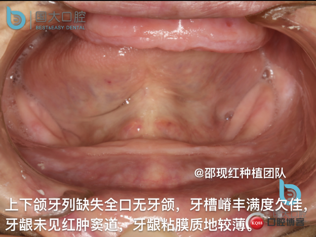 王月秀 下颌种植四颗 下颌骨严重萎缩.004.jpeg