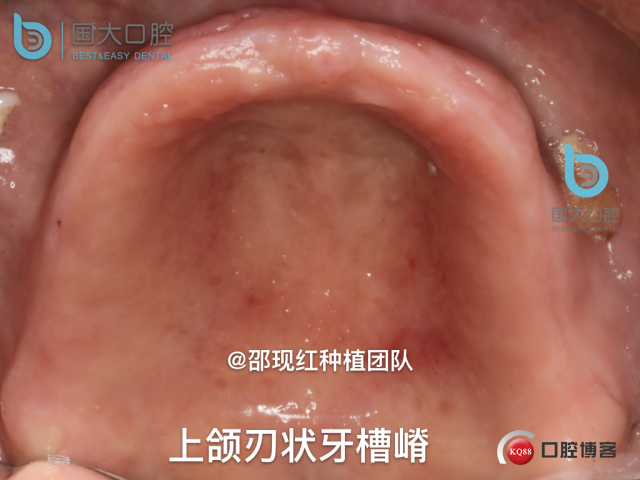 王月秀 下颌种植四颗 下颌骨严重萎缩.006.jpeg