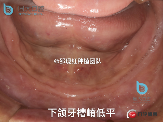 王月秀 下颌种植四颗 下颌骨严重萎缩.007.jpeg