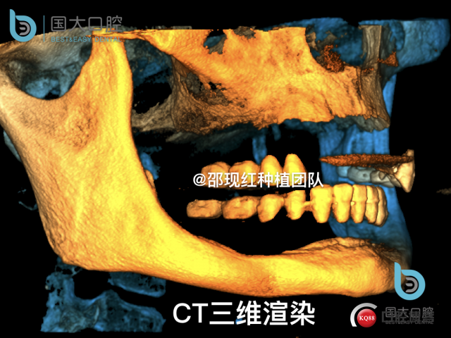 王月秀 下颌种植四颗 下颌骨严重萎缩.009.jpeg