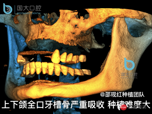 王月秀 下颌种植四颗 下颌骨严重萎缩.010.jpeg