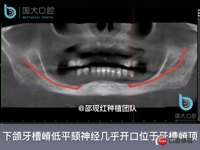 王月秀 下颌种植四颗 下颌骨严重萎缩.011.jpeg