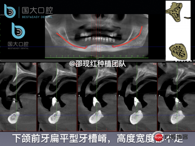 王月秀 下颌种植四颗 下颌骨严重萎缩.014.jpeg
