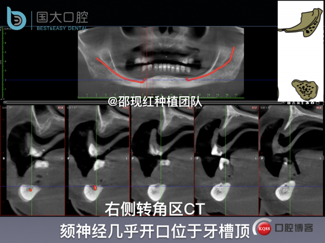 王月秀 下颌种植四颗 下颌骨严重萎缩.015.jpeg