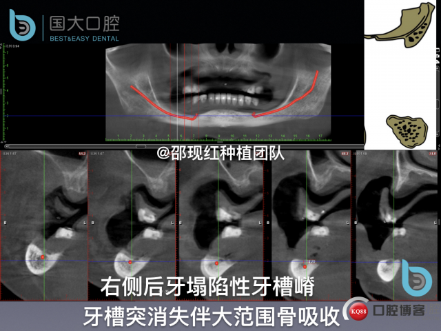 王月秀 下颌种植四颗 下颌骨严重萎缩.016.jpeg