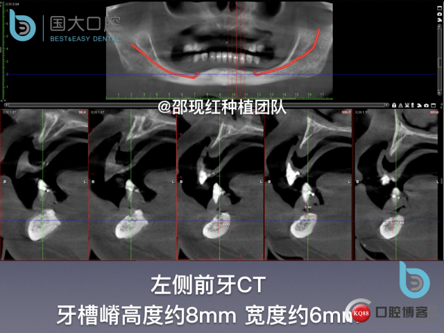 王月秀 下颌种植四颗 下颌骨严重萎缩.017.jpeg