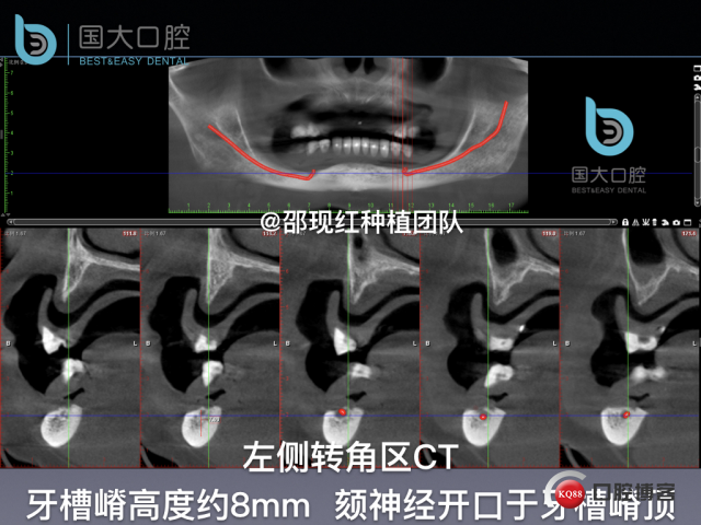 王月秀 下颌种植四颗 下颌骨严重萎缩.018.jpeg