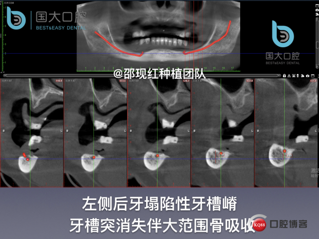 王月秀 下颌种植四颗 下颌骨严重萎缩.019.jpeg
