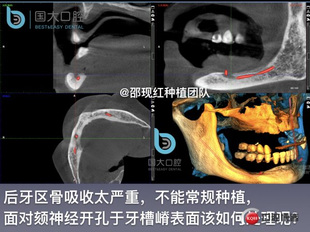王月秀 下颌种植四颗 下颌骨严重萎缩.020.jpeg