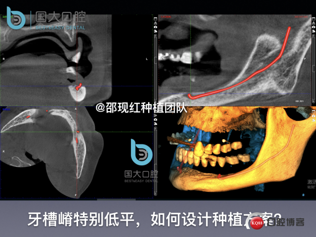 王月秀 下颌种植四颗 下颌骨严重萎缩.021.jpeg