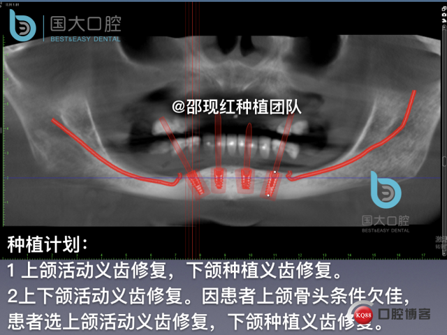 王月秀 下颌种植四颗 下颌骨严重萎缩.022.jpeg