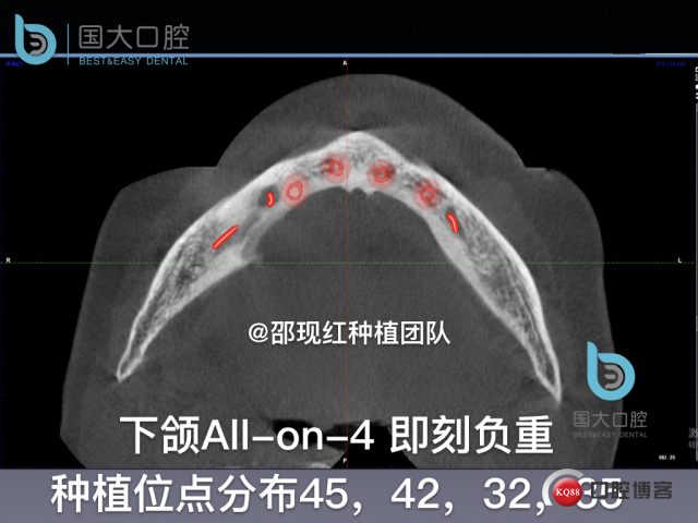 王月秀 下颌种植四颗 下颌骨严重萎缩.023.jpeg